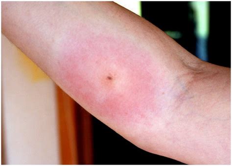 Wolf Spider Bite Symptoms Treatment Pictures Prevention Remedy