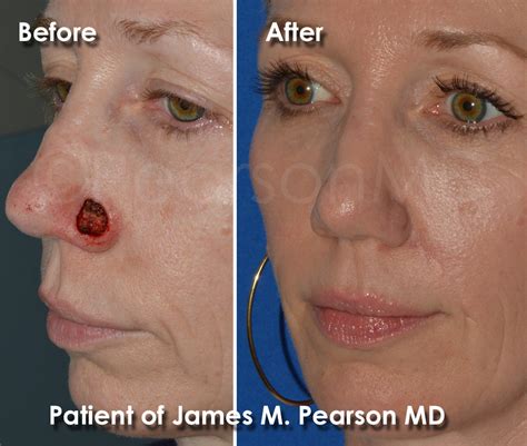 Photo Gallery Reconstructive Dr James Pearson Facial Plastic Surgery