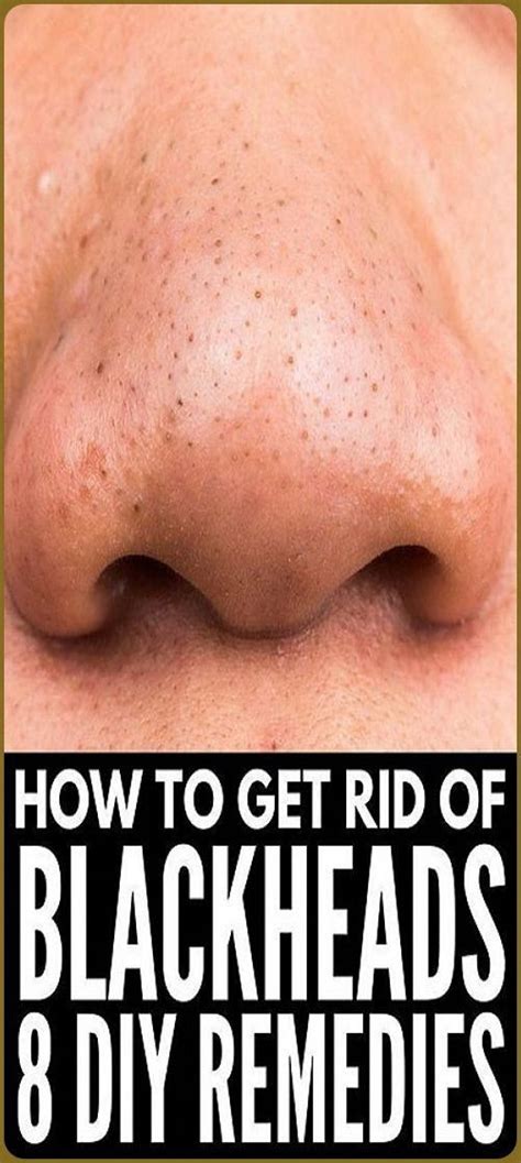 Remove Blackheads With One Simple And Effective Trick Blackheads How