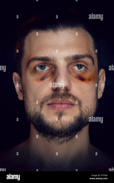 Face Bruise Hi Res Stock Photography And Images Alamy