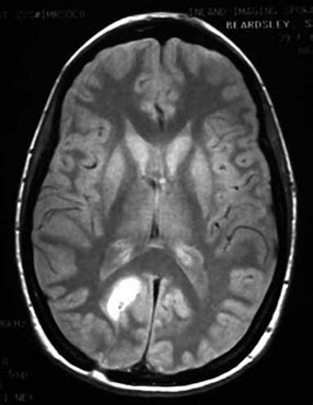 Brain tumors are rare, so most doctors do not think of brain tumors right away. (a) Original MRI brain tumor image (b) Colored MRI image ...
