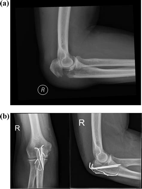 A Pre Operative X Ray Of Displaced Olecranon Fracture B