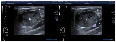 Clinical Value Of Ultrasonic Imaging In Diagnosis Of Hypopharyngeal