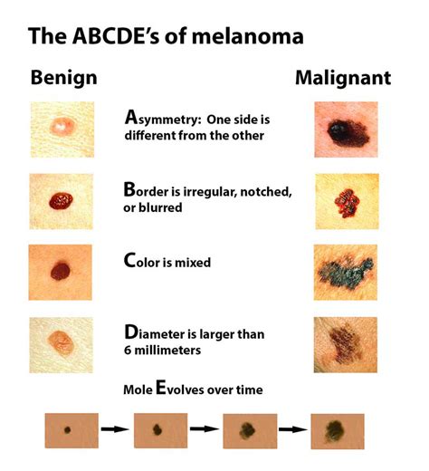 If it has the classic signs of melanoma as evaluated by a dermatologist, there is a good chance that it will be a melanoma when a sample is sent out for pathology. there is no quantitative data on what percentage of this mole looks suspicious or i don't like the way this looks ends up being melanoma. Melanoma - Harvard Health