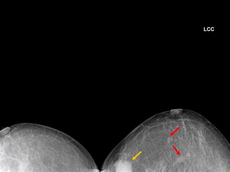 Atlas Of Breast Cancer Early Detection