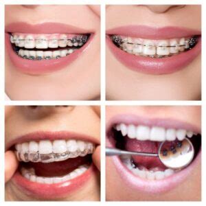 Por Que Los Precios En Ortodoncia Var An Tanto Cl Nica Dental