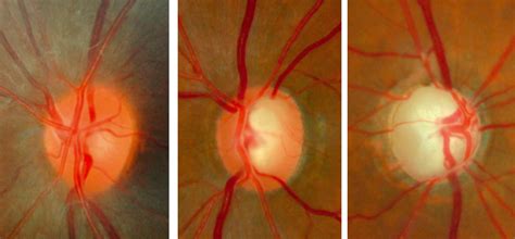 Community Eye Health Journal The Optic Nerve Head In Glaucoma
