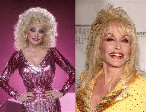 Dolly Parton Plastic Surgery Before And After Celeb Surgerycom