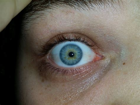 The occurrence of this condition is usually random, and it central heterochromia is often mistaken for the hazel eye color, but there is a key difference. Is this central heterochromia? : eyes