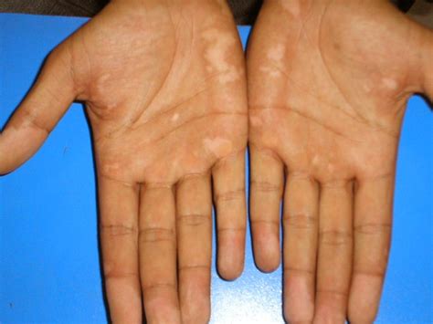 Vitiligo Pictures Symptoms Causes Treatment 2021 Updated