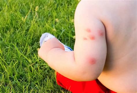Baby Bed Bug Bites Cure Steadfast Podcast Bildergallerie