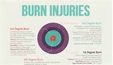 Pictures of What Are The Degrees Of Burns