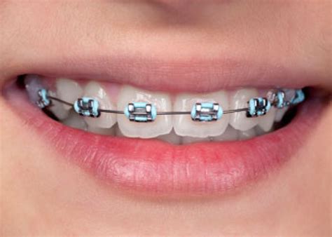 Vibrant Coloured Braces In Langley Personalize Your Smile