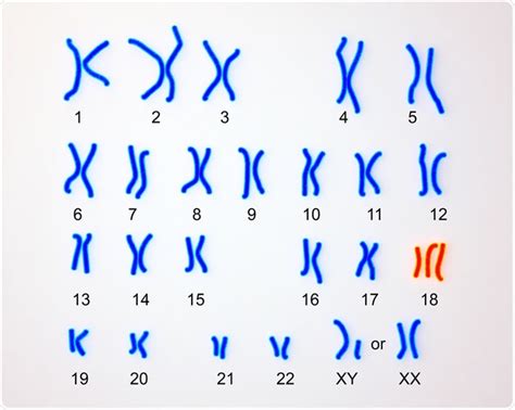 What Is Edwards Syndrome