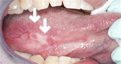 Precancerous changes in the mouth may be visualized as white spots (leukoplakia). NYU Oral Cancer Center: Oral precancer