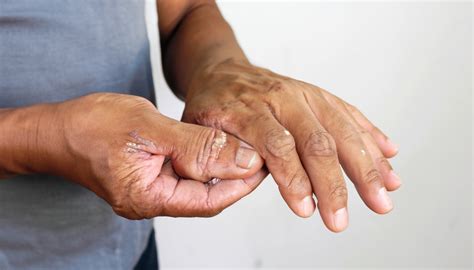 What Are The Early Warning Signs Of Psoriatic Arthritis Expert Guide