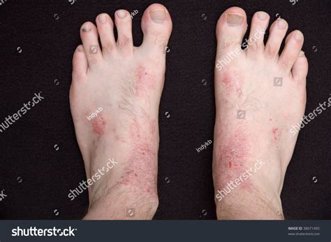 Atopic Eczema On Skin Persons Feet Stock Photo 38071495 Shutterstock