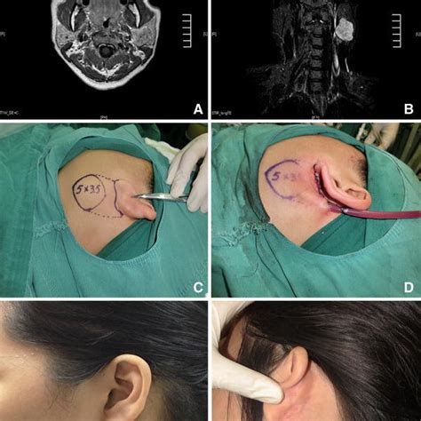 Endoscope Assisted Extracapsular Dissection Of Benign Parotid Tumors