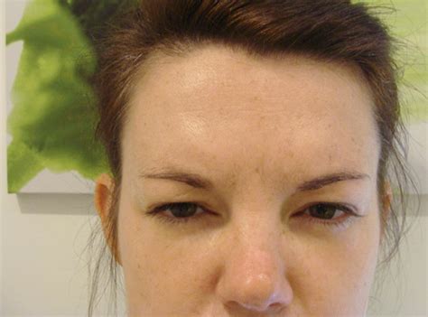 Efectos secundarios botox en la cara consecuencias. Consecuencias de Botox para la cara: efectos secundarios y ...