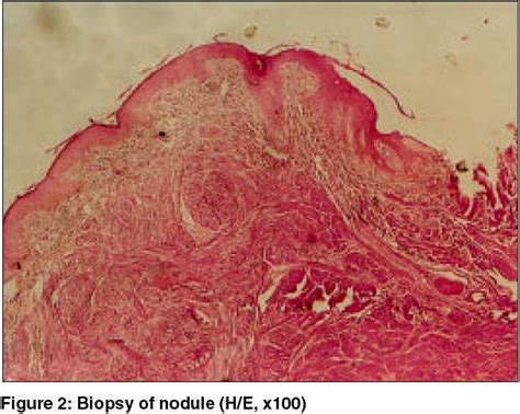 Multiple Painful Nodules Indian Journal Of Dermatology Venereology And Leprology