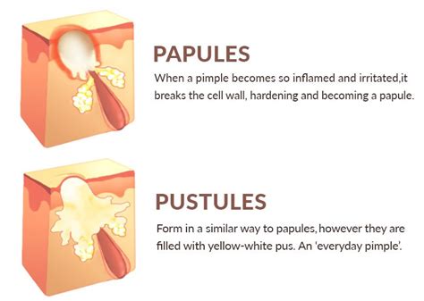 How To Get Rid Of Papules