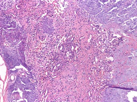 Pathology Outlines Phosphaturic Mesenchymal Tumor