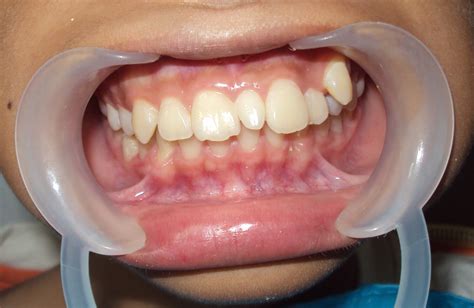Toothfulness Got Extra Tooth