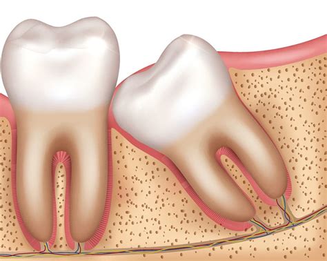 The policies of insurance companies differ, but some companies will cover for the cause only when it can lead to infection or permanent damage if not removed. Wisdom Teeth Removal Cost Without Insurance 2017 - TeethWalls