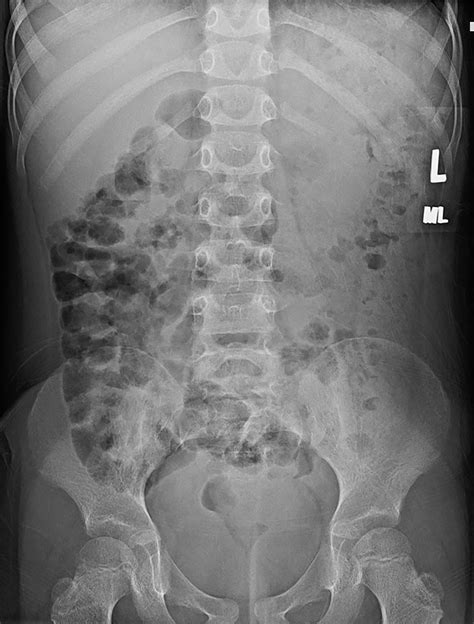 More Than An Achy Back Spinal Epidural Abscess Radiology Key