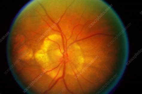 Graves Ophthalmopathy Stock Image C0031374 Science Photo Library