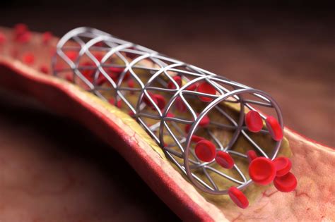 Best Coronary Stents From The Top Brands Idata Research