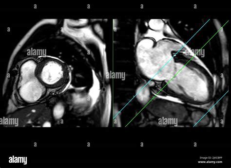 Mri Heart Or Cardiac Mri Magnetic Resonance Imaging Of Heart In