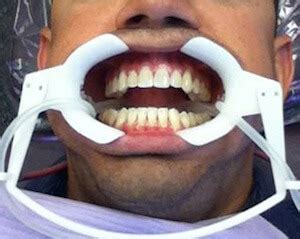 7 be sure to get dental coverage before you start working with an orthodontist. How Much Do Braces Cost?