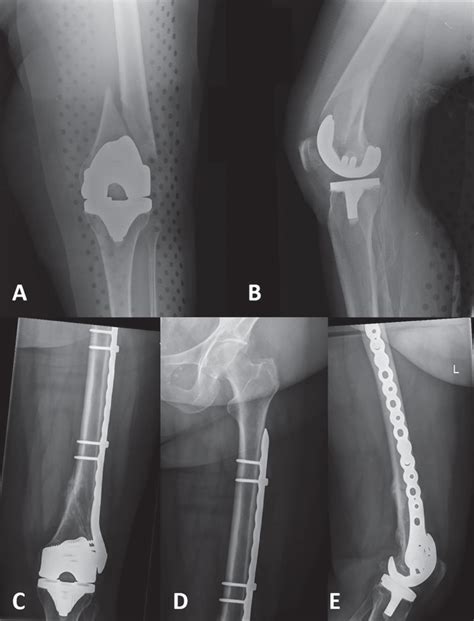 Periprosthetic Fractures Knee Musculoskeletal Key