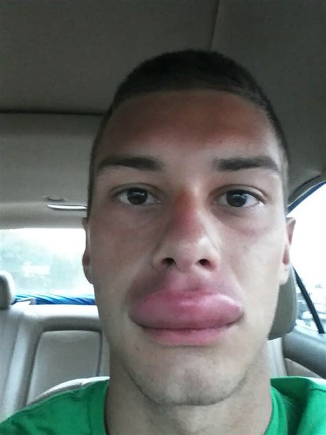 People Share Their Worst Bee Sting Lips Metro News