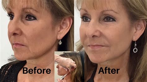 Trendingword.com has been visited by 10k+ users in the past month How to Get Rid of Jowls with Dermal Fillers! Step 2 - YouTube