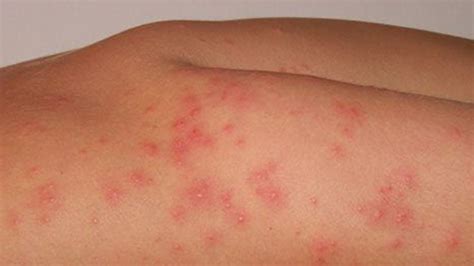 Cercarial Dermatitis Symptoms Treatment And More