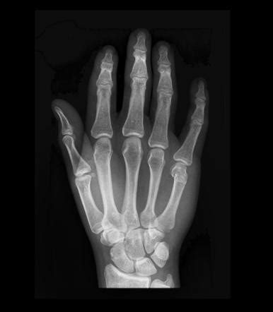 Boxer Fracture Radiology Case Radiopaedia Org