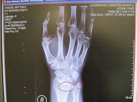 The story of my broken wrist