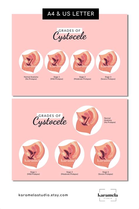 Printable Diagram Of Cystocele Grading Stages Of Cystocele Etsy Uk In