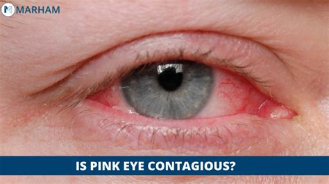 Conjunctivitis Symptoms Is Pink Eye Contagious Marham