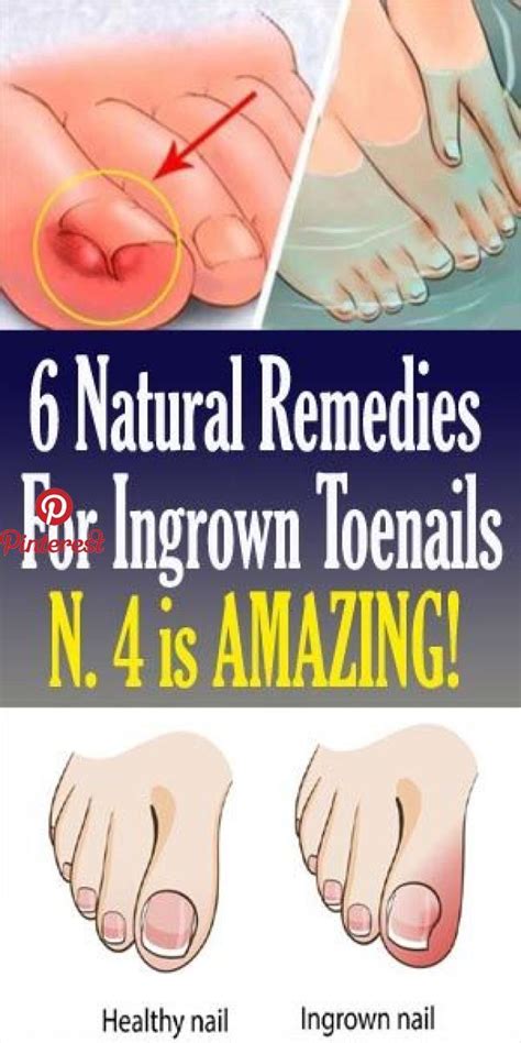 6 Natural Remedies For Ingrown Toenails 6 Natural Remedies For Ingrown