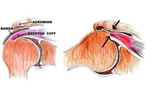 Shoulder Impingement Bursitis Rotator Cuff Tendonitis Dr Sher