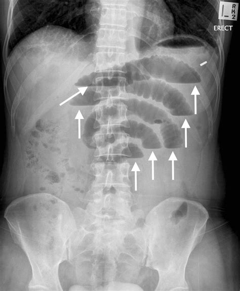 Small Bowel Obstruction Stepwards