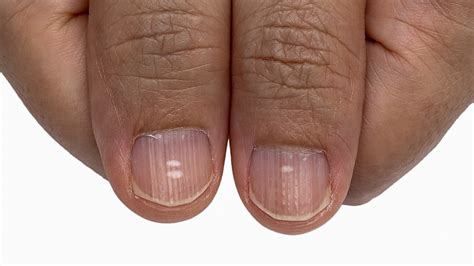 7 Common Nail Conditions And Their Causes Listsng