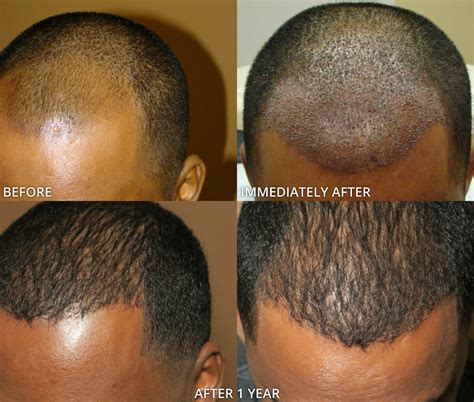 Przeszczep włosów Chicago zdjecia przed i po Przeszczep włosów Chicago
