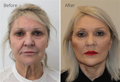 Facelift Necklift Before And After Photos Ap View The Karri Clinic