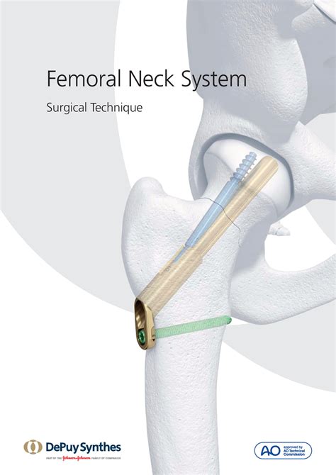 Fns Technique Guide Lecture Notes Fdee Femoral Neck System Surgical
