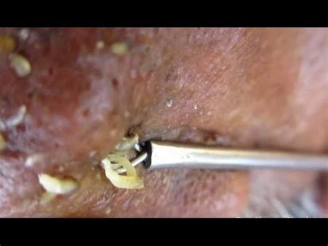 Other relaxing videos you can watch 1. Blackheads extraction on nose Blackhead Remover Tool - YouTube