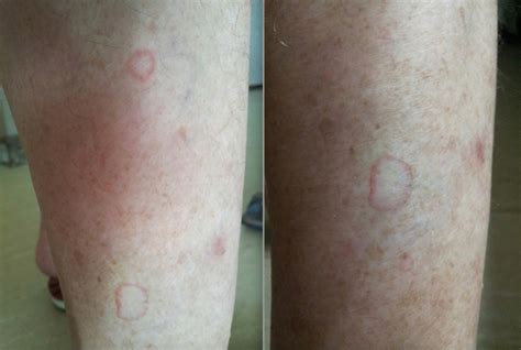 Uvb Treatment Does It Work Granuloma Annulare Forums Patient